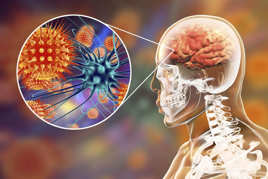Meningitis Bacteriana